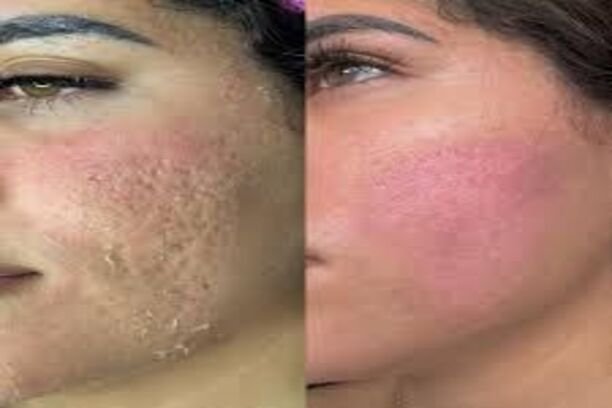 Microneeavantapres (1)